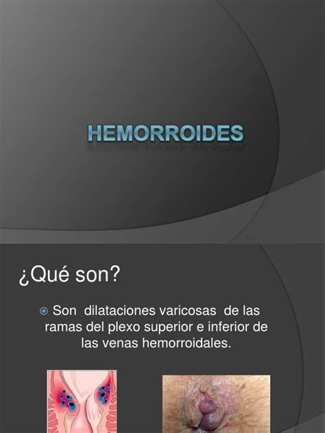 hemorroides externas fotos|Hemorroides externas [almorranas]: qué son, síntomas y cómo。